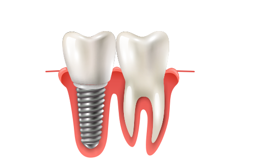 Implantes dentales en madrid